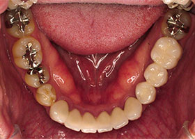 下の歯