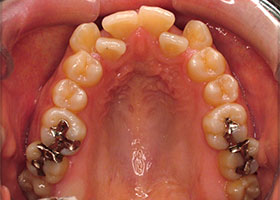 上の歯