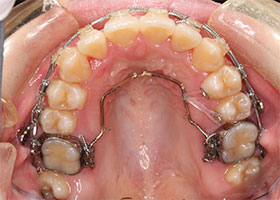 上の歯